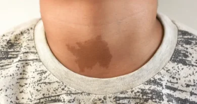 La Marque Sacrée Ces Taches de Naissance Révèlent elles un Passé Mystérieux