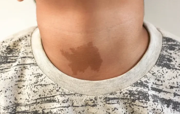 La Marque Sacrée Ces Taches de Naissance Révèlent elles un Passé Mystérieux